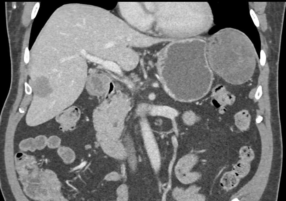 Omental Infarction s/p Distal Pancreatectomy and Splenectomy - CTisus CT Scan