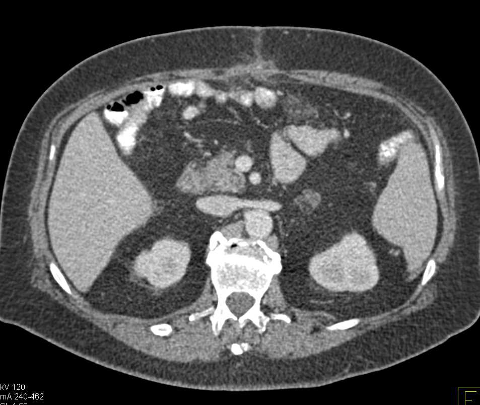 Abscess LLQ and Abdominal Wall in Post Operative Patient - CTisus CT Scan