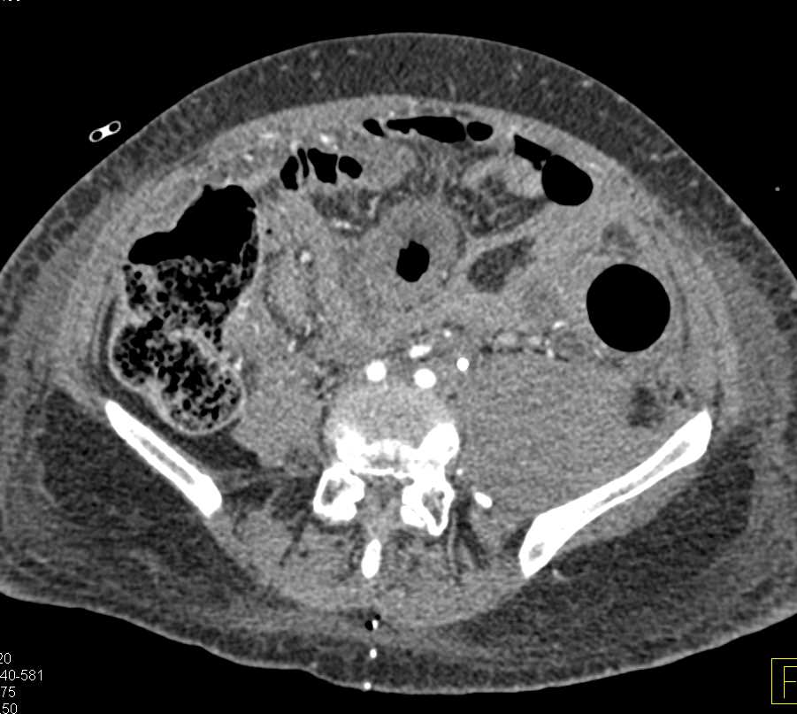 Rectal Carcinoma with Carcinomatosis and Extensive Pelvic Disease - CTisus CT Scan