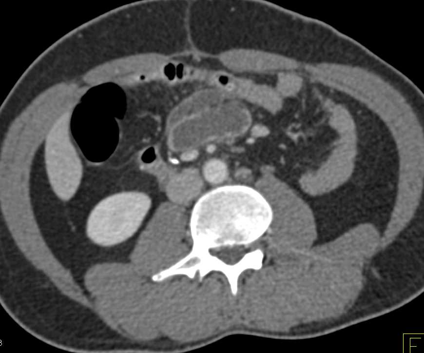 Colitis with Cystic Mesenteric Nodes due to Mycobacterium avium/intracellulare (MAI) Infection - CTisus CT Scan