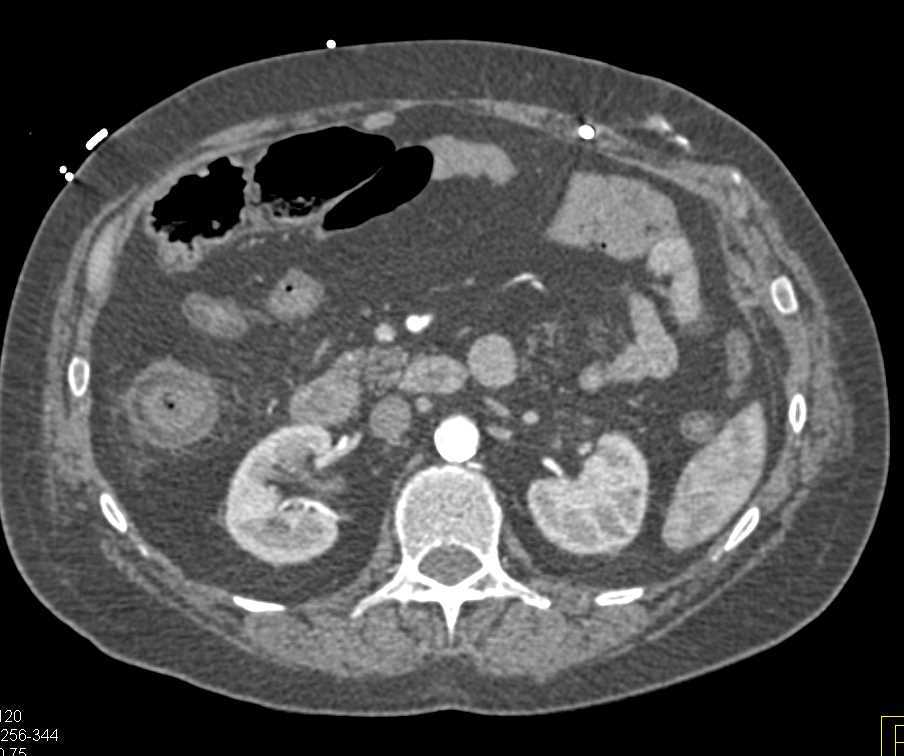 Halo Sign with Crohn's Colitis - CTisus CT Scan