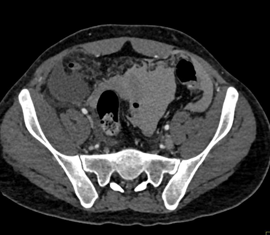 Hemoperitoneum - CTisus CT Scan