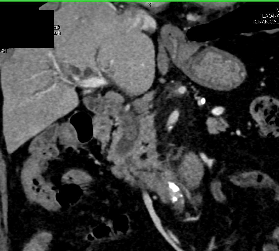 Impacted Stone in Dilated Common Bile Duct - CTisus CT Scan