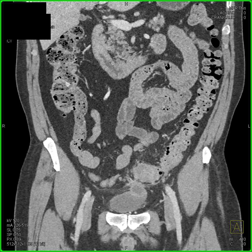 Diverticulitis with Fistulae to Dome of Bladder for Enterovesical Fistulae - CTisus CT Scan