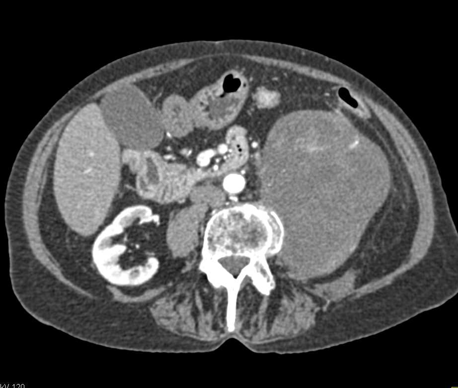 Neurogenic Sarcoma - CTisus CT Scan