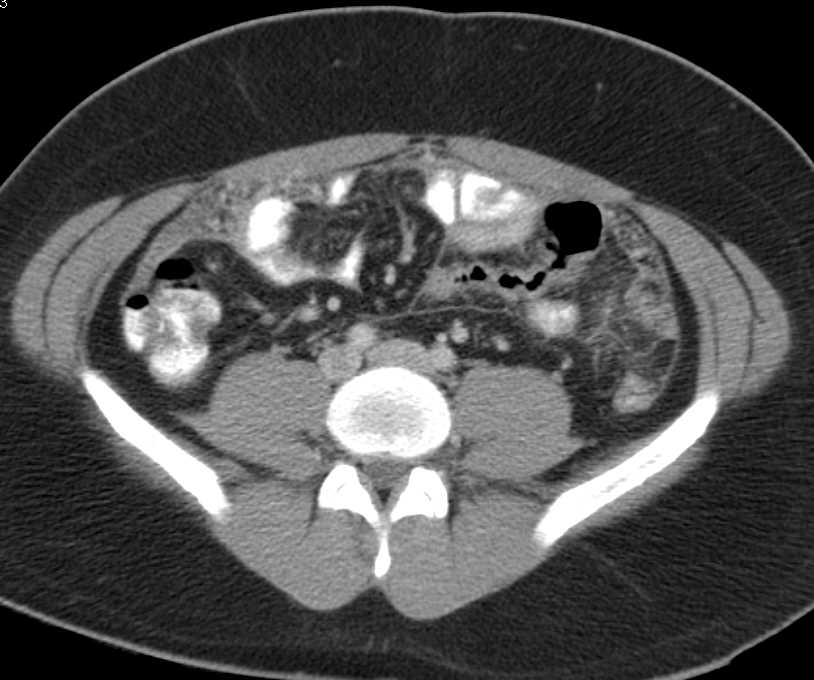 Carcinomatosis - CTisus CT Scan