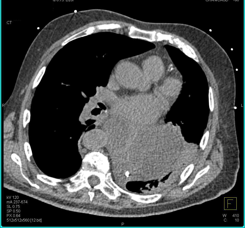 Large Hiatal Hernia Prone to Volvulus - CTisus CT Scan