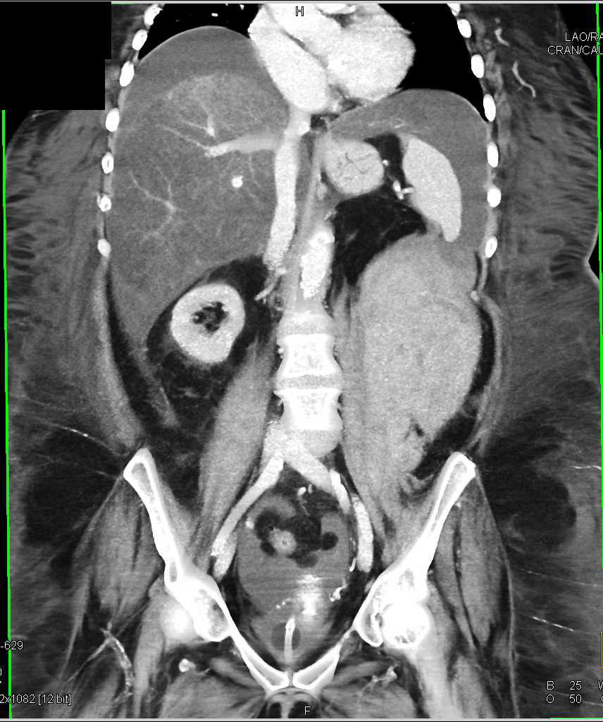 Spontaneous Left Retroperitoneal Bleed - CTisus CT Scan