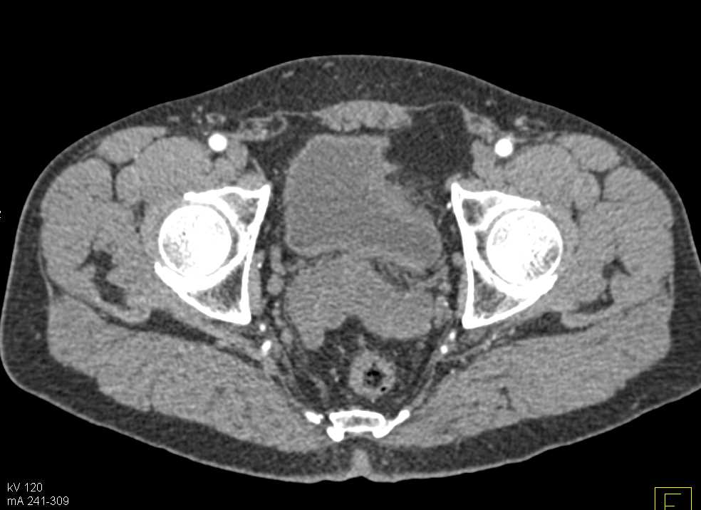 Enlarged Prostate - CTisus CT Scan