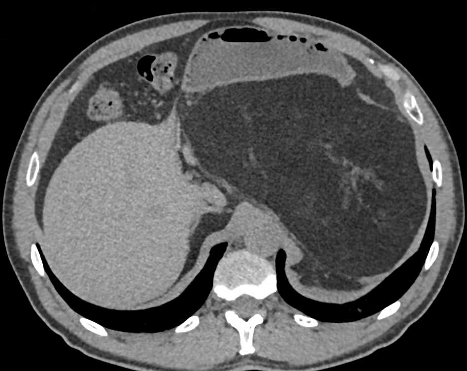 Retroperitoneal Liposarcoma - CTisus CT Scan