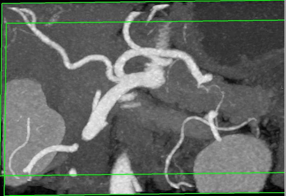 Celiac and Superior Mesenteric Artery (SMA) Arise from a Common Trunk - CTisus CT Scan