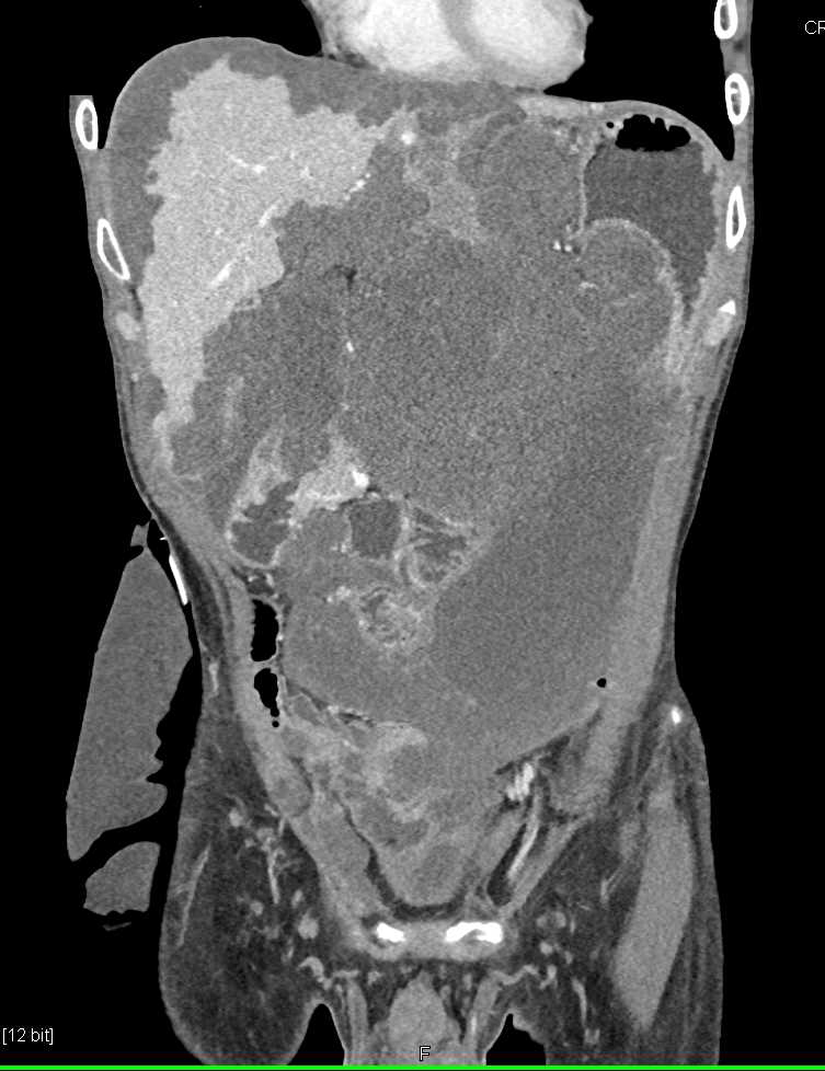 Pseudomyxoma Peritonei (PMP) with Scalloping of the Liver Margins - CTisus CT Scan