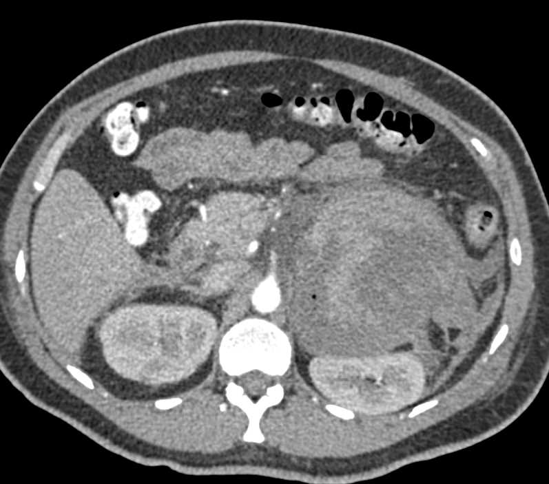 Large Left Upper Quadrant Bleed due to Underlying Tumor - CTisus CT Scan