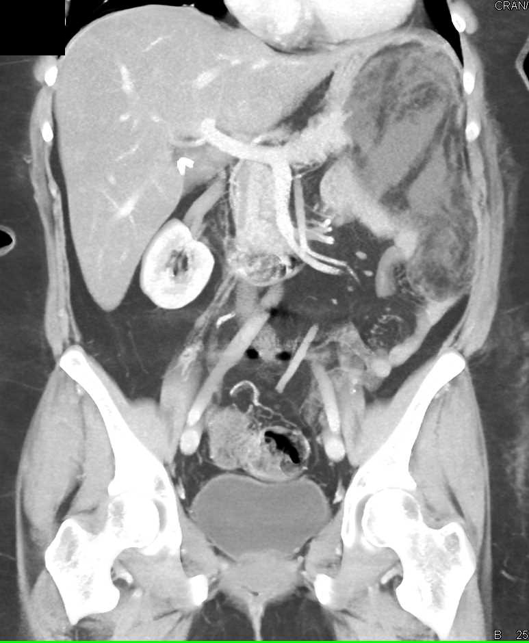 Omental Infarction Left Upper Quadrant Following Distal Pancreatectomy and Splenectomy - CTisus CT Scan