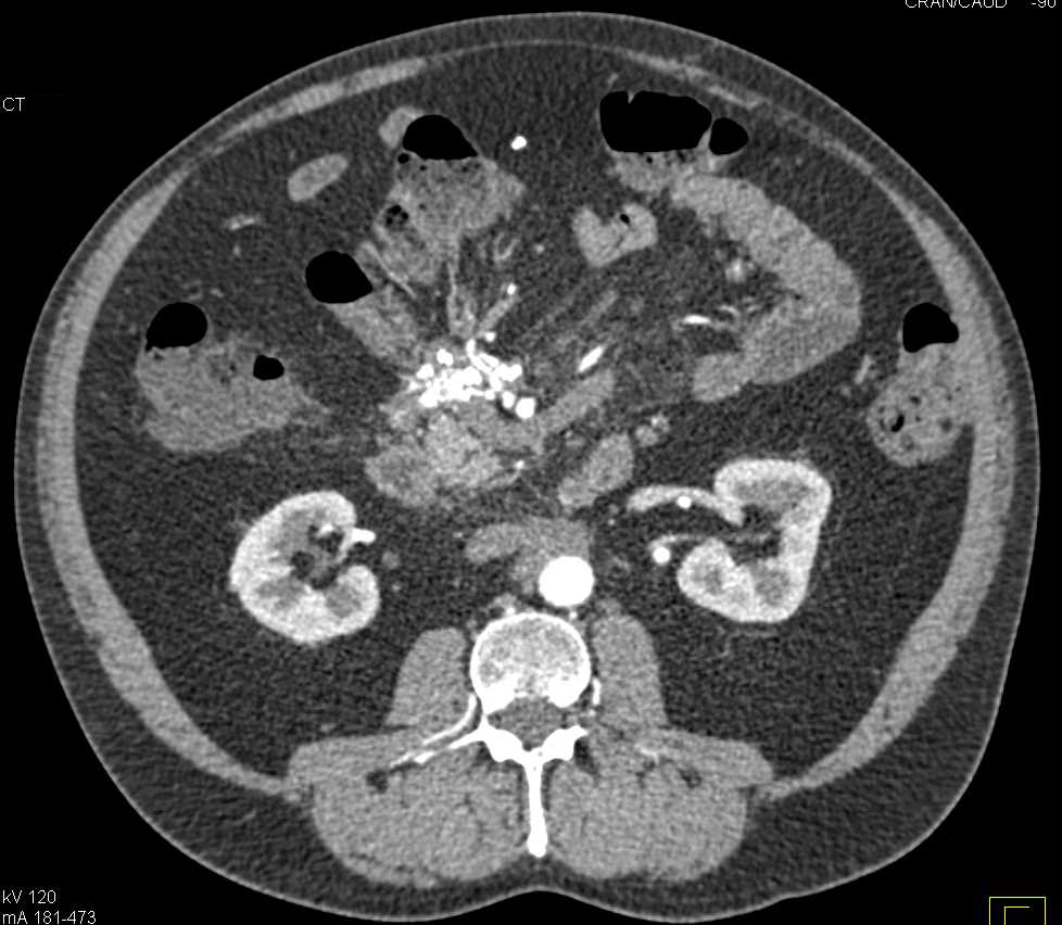 Sclerosing Mesenteritis Simulates a Carcinoid Tumor - CTisus CT Scan