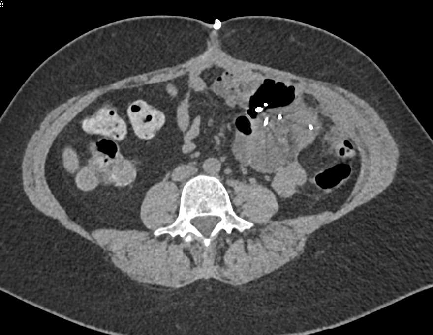 Patient Swallowed Multiple Safety Pins - CTisus CT Scan