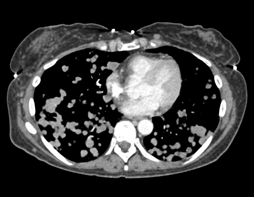 Melanoma with Numerous Lung Metastases, Carcinomatosis and Multiple Organ Metastases - CTisus CT Scan