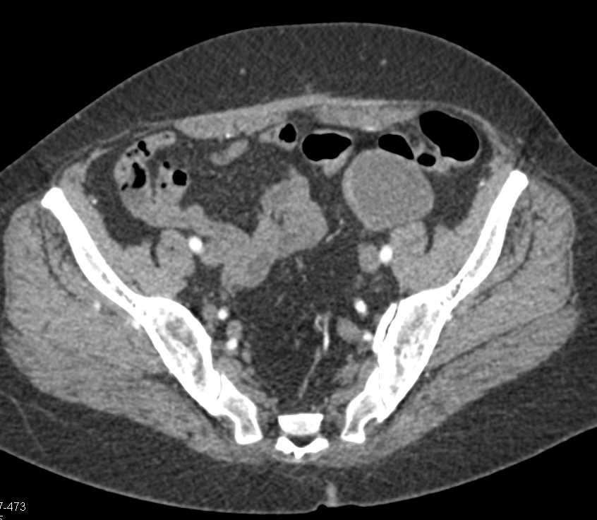 Mesenteric Cyst Left Lower Quadrant - CTisus CT Scan