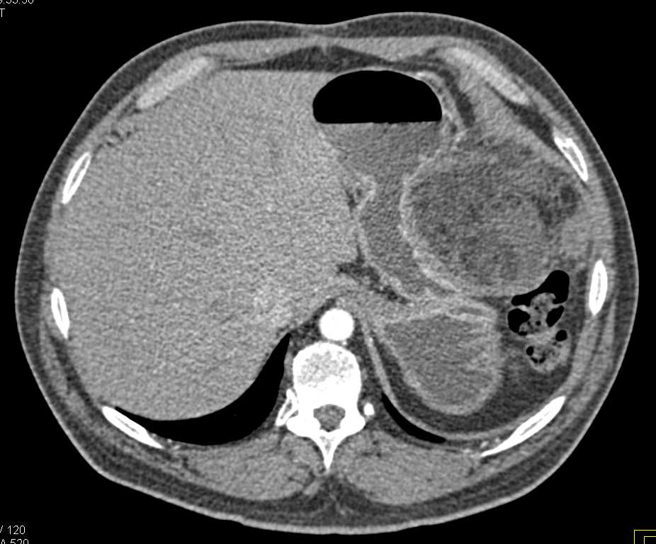 Omental Infarct Left Upper Quadrant Following Distal Pancreatectomy and Splenectomy - CTisus CT Scan