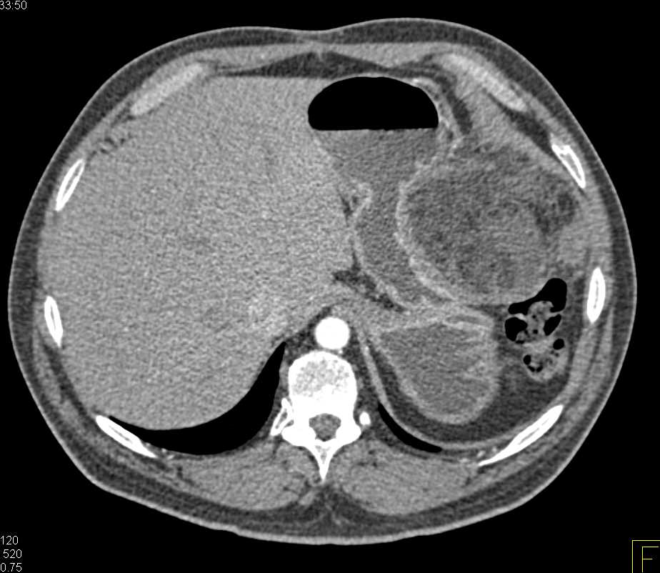 Omental Infarct Left Upper Quadrant Following Distal Pancreatectomy and Splenectomy - CTisus CT Scan