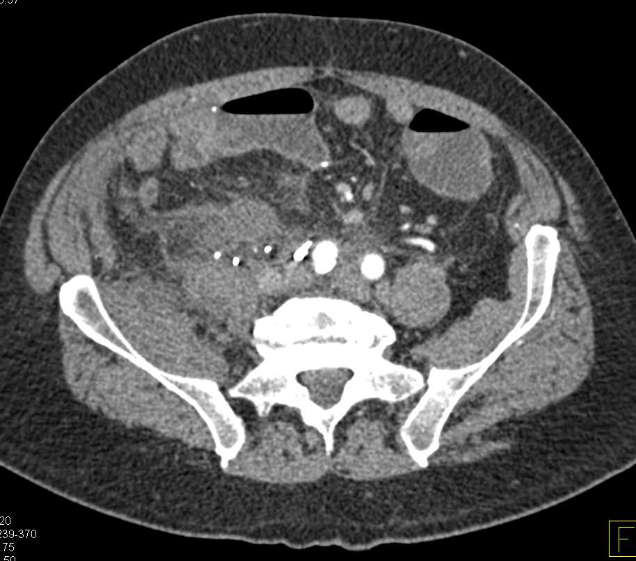 Large Seroma in the Right Lower Quadrant - CTisus CT Scan