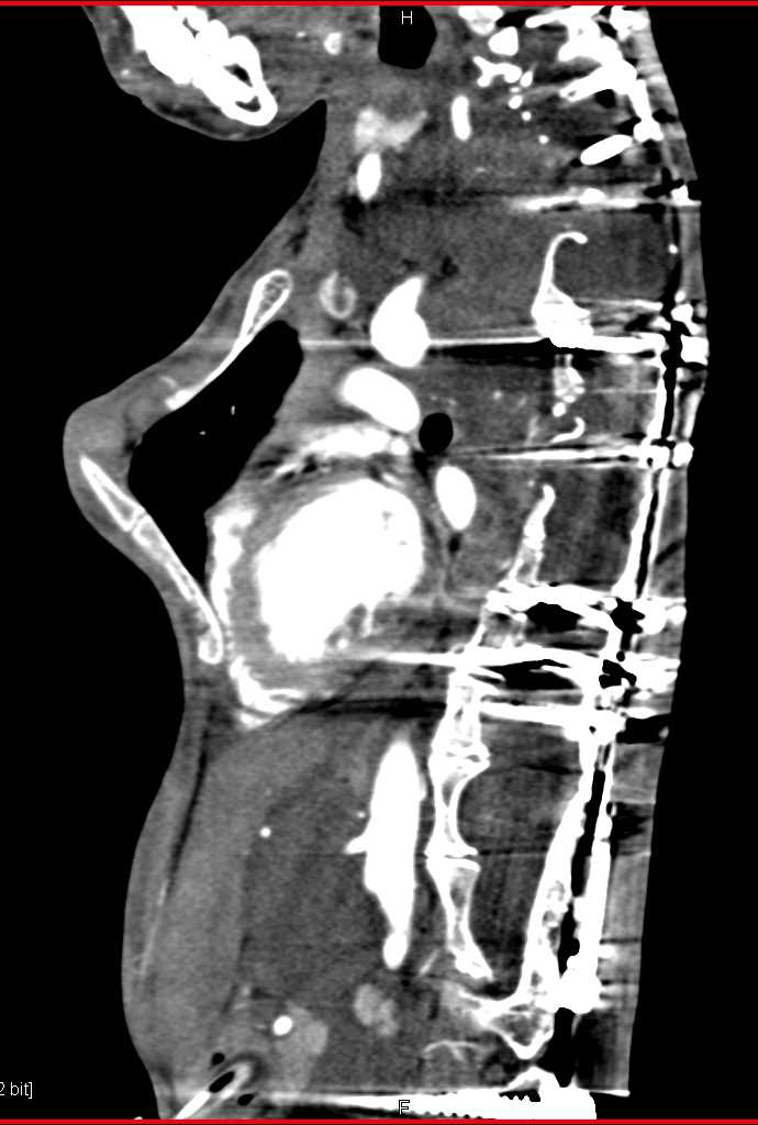 Extensive Neurofibromatosis in the Chest and Abdomen - CTisus CT Scan