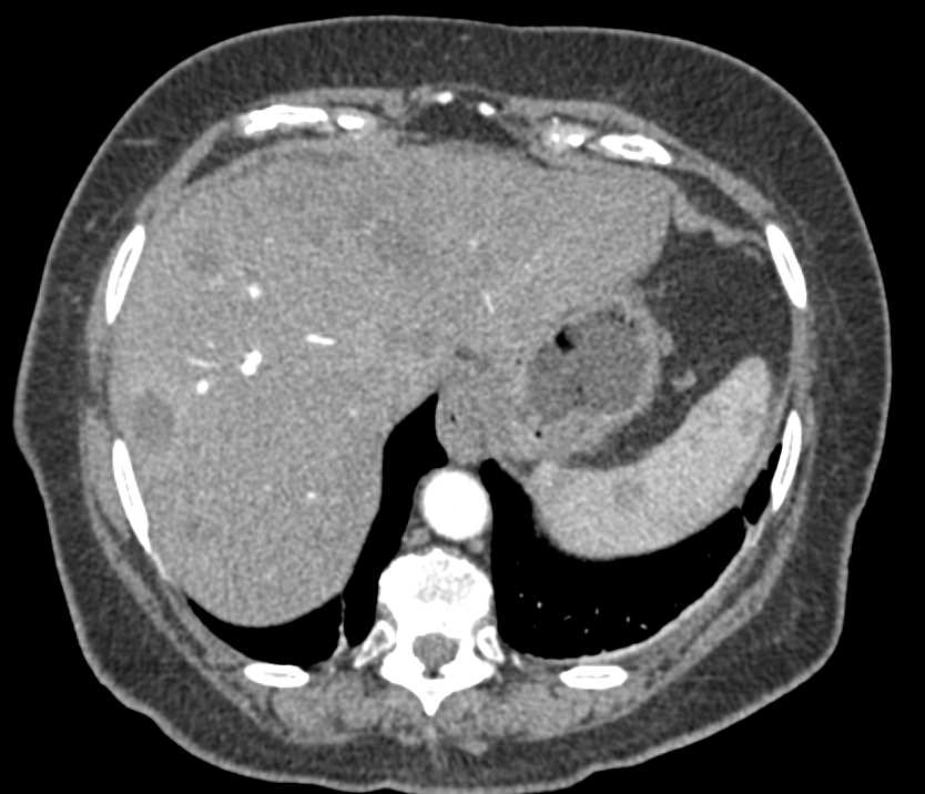 Choledochal Cyst Common Bile Duct with Endoscopic Retrograde Cholangiopancreatography (ERCP) - CTisus CT Scan