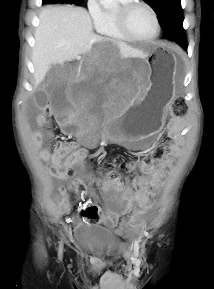 Gastric Cancer with Pseudomyxoma Peritonei (PMP) - CTisus CT Scan