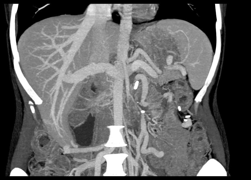 Infiltrating Duodenal Carcinoma - CTisus CT Scan