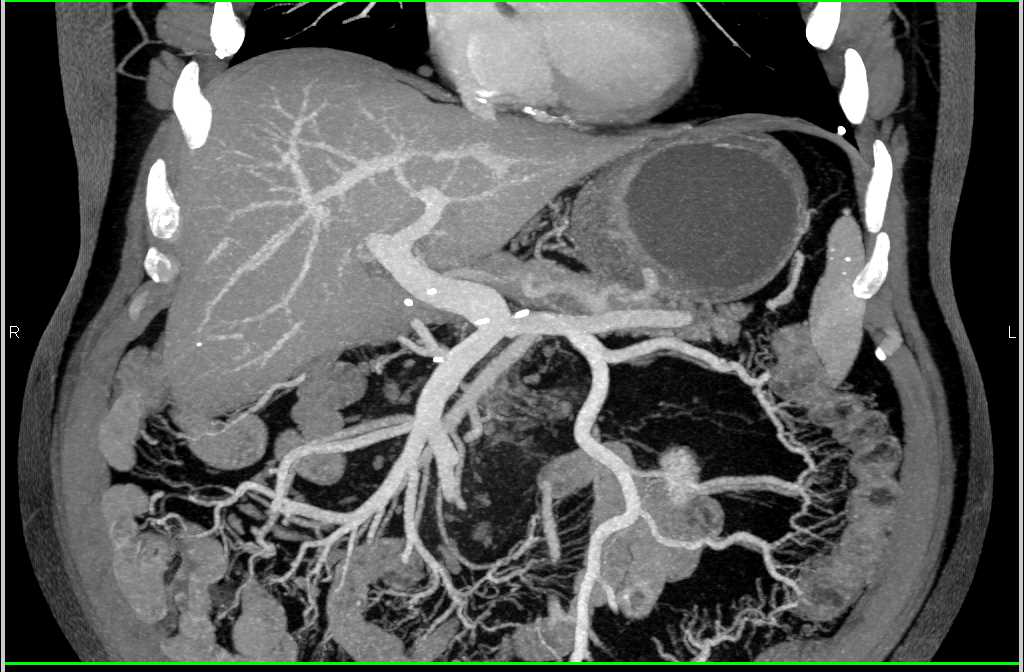 Vascular Map of Arterial and Venous Display to Mesentery - CTisus CT Scan