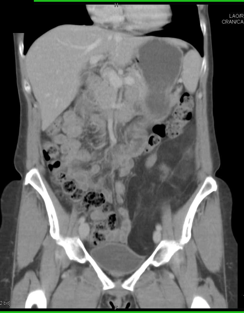 Retroperitoneal Liposarcoma in Left Lower Quadrant - CTisus CT Scan