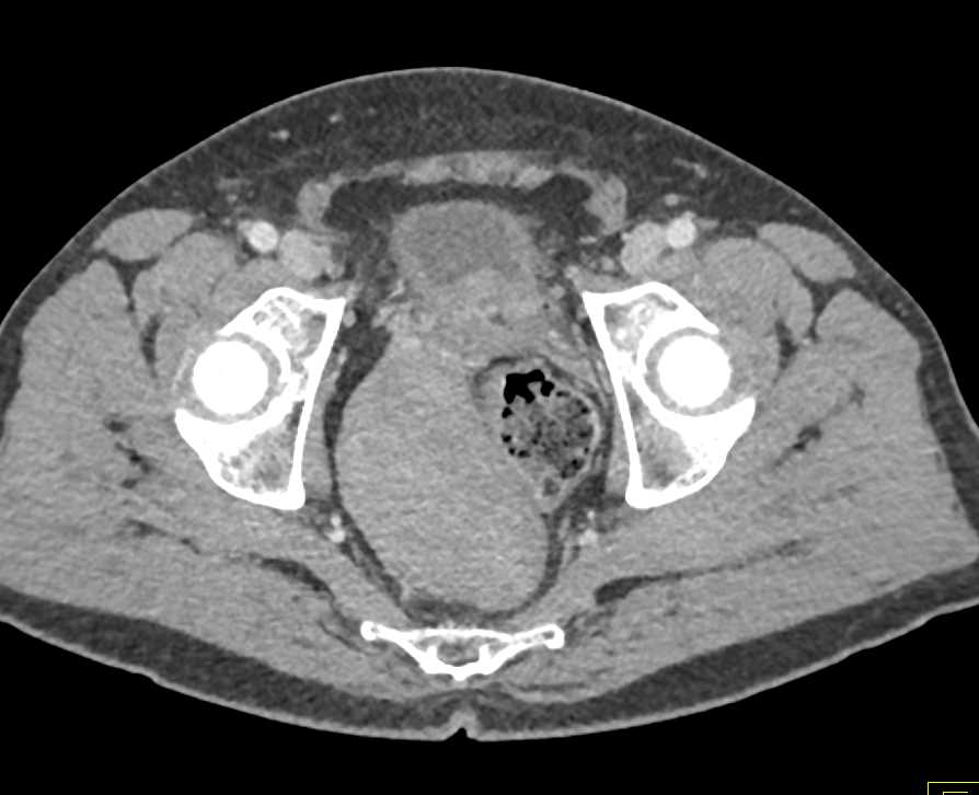 Sarcoma in Lower Pelvis Pushes on the Rectum - CTisus CT Scan
