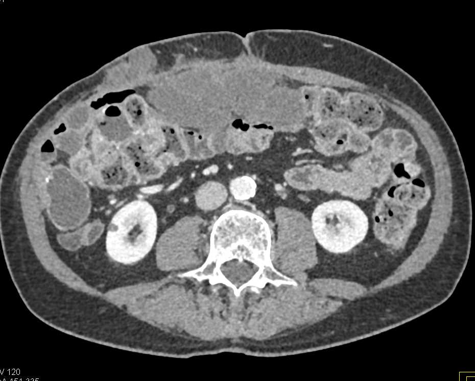 Metastatic Adenocarcinoma to Omentum and Subcutaneous Tissues Abdominal Wall - CTisus CT Scan