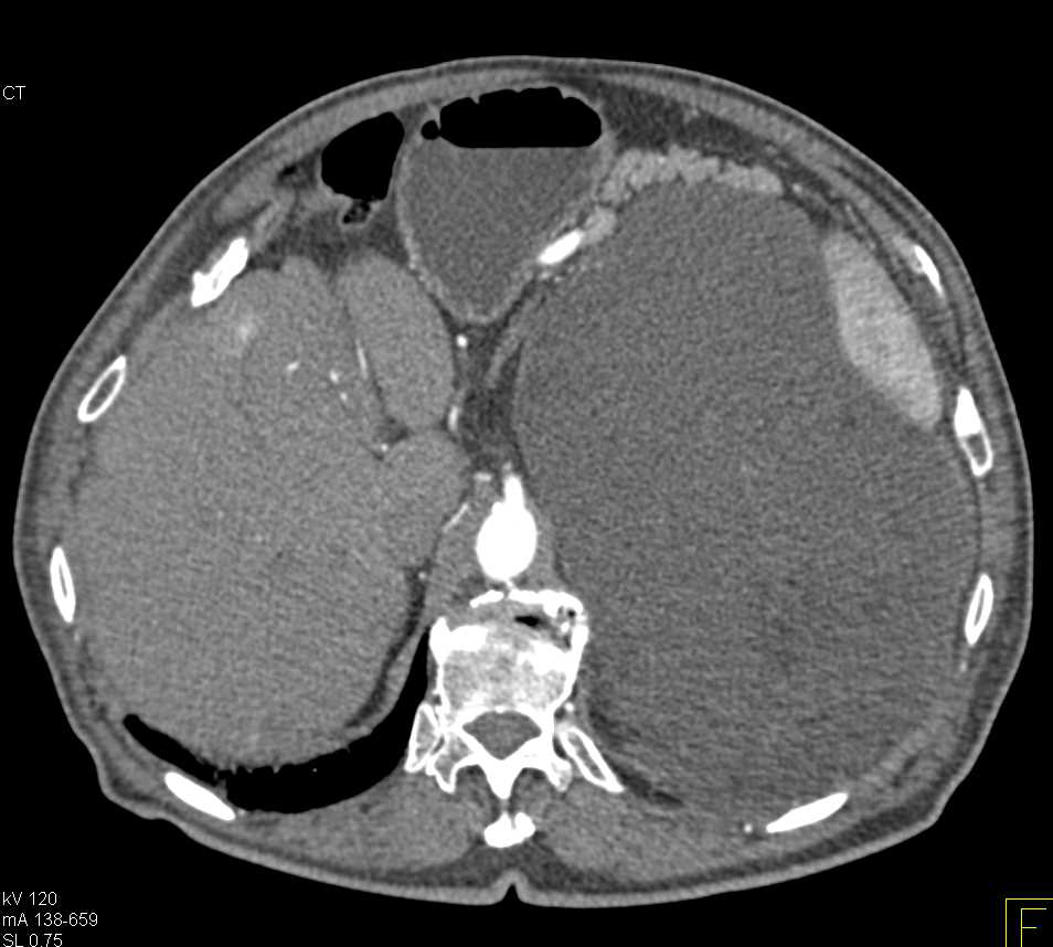 Retroperitoneal Liposarcoma in Left Lower Quadrant - CTisus CT Scan