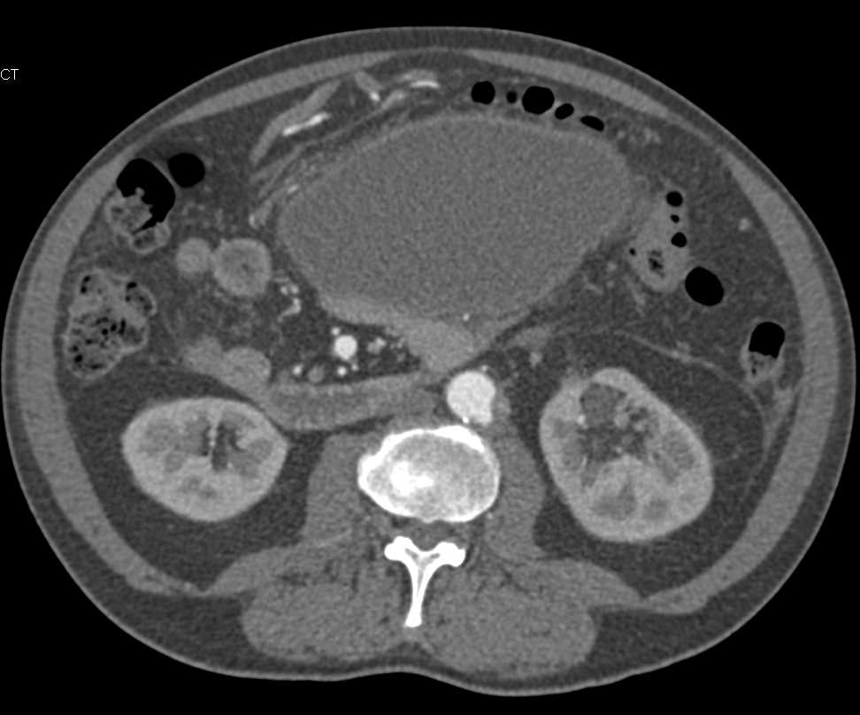 Pelvic Hemorrhage and Large Pseudocyst - CTisus CT Scan