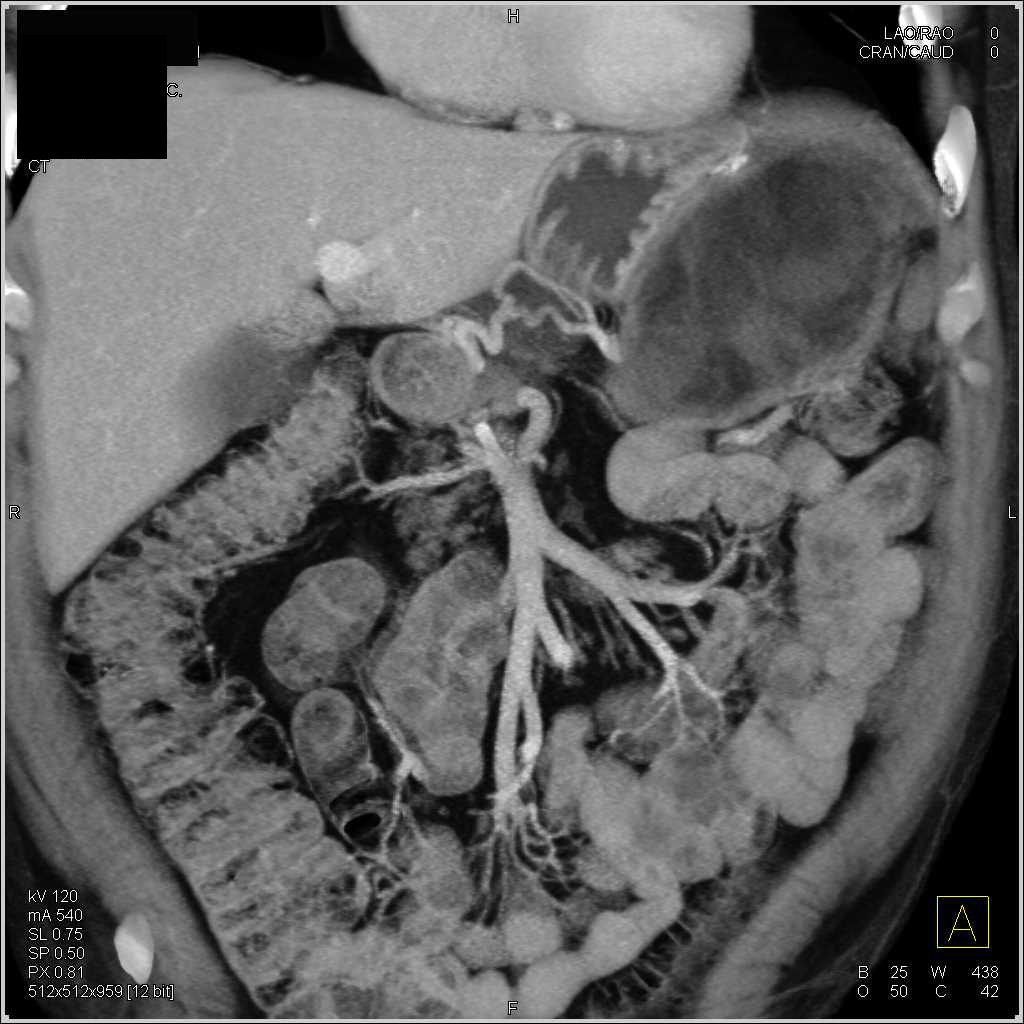Omental Infarct in Left Upper Quadrant - CTisus CT Scan
