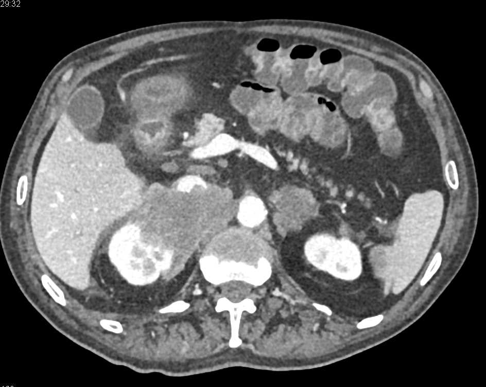 Metastatic Melanoma to Adrenal, Pancreas and Adenopathy - CTisus CT Scan