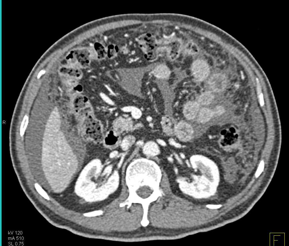 Ascites with Carcinomatosis - CTisus CT Scan