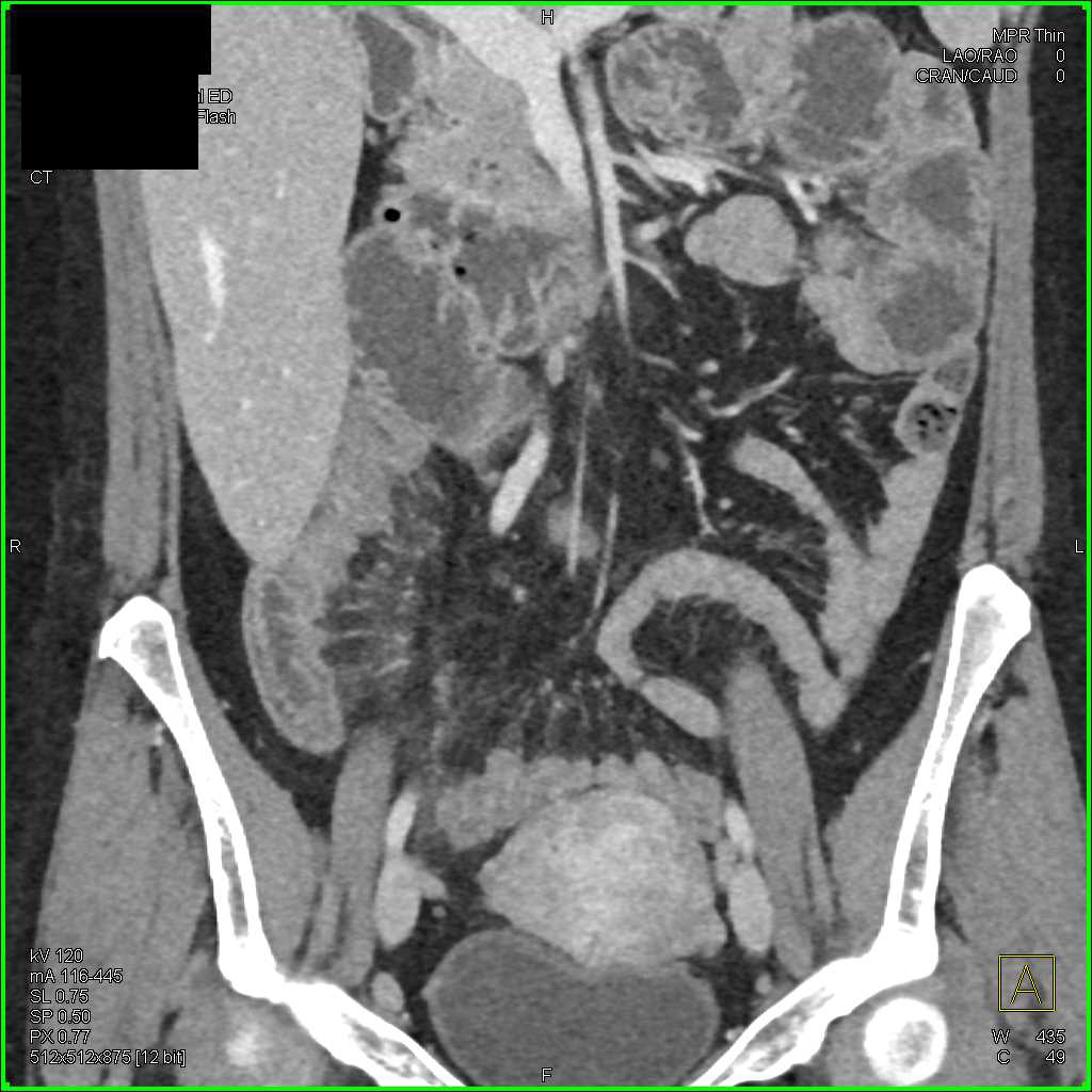 Cyst Near Gastric Fundus and Crohn's Disease Terminal Ileum - CTisus CT Scan