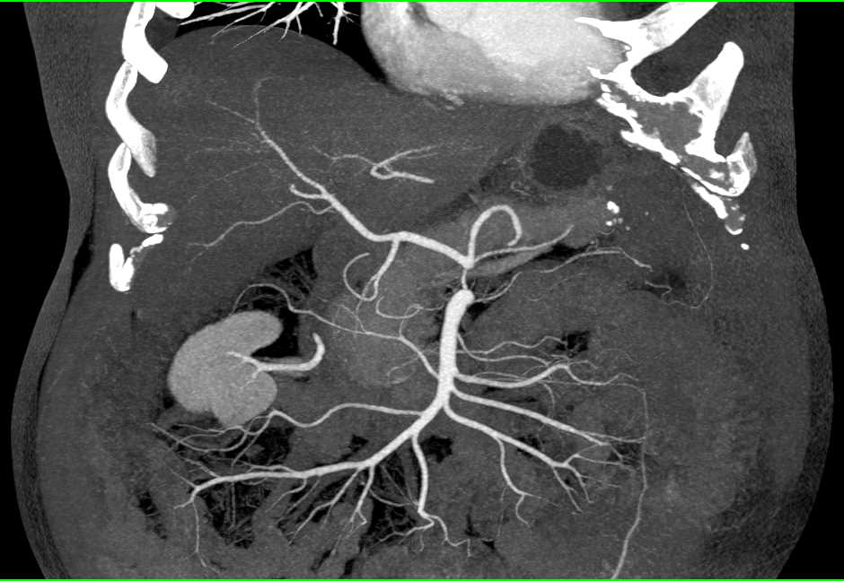 Infarct Left Upper Quadrant in Post Operative Patient - CTisus CT Scan