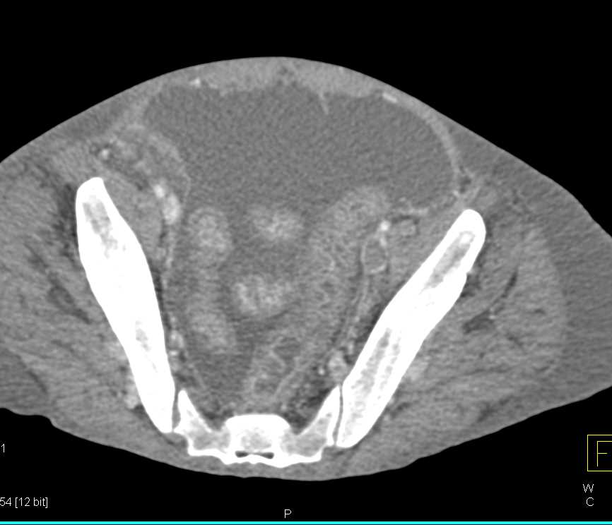 Enteritis with Ascites - CTisus CT Scan