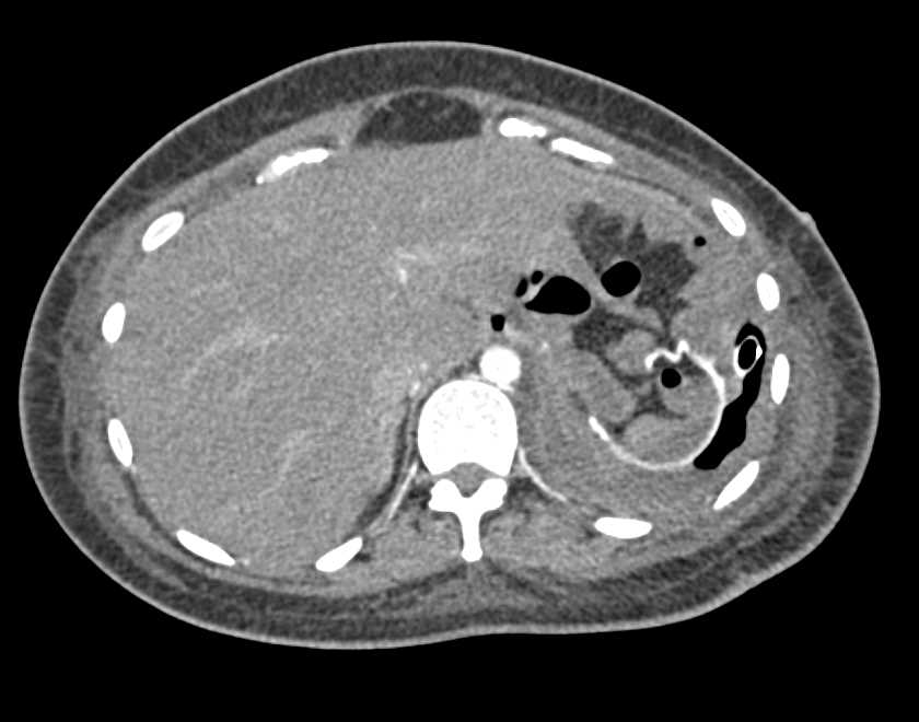 Left Upper Quadrant Abscess - CTisus CT Scan