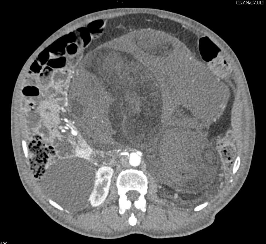 Large Retroperitoneal Liposarcoma - CTisus CT Scan