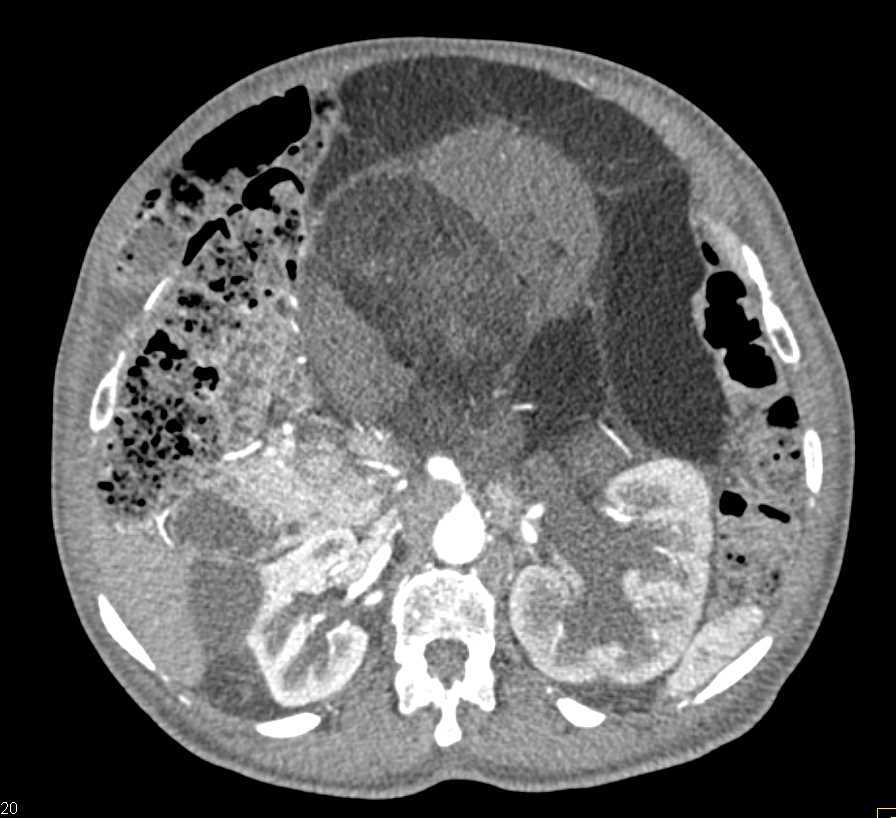 Large Retroperitoneal Liposarcoma - CTisus CT Scan