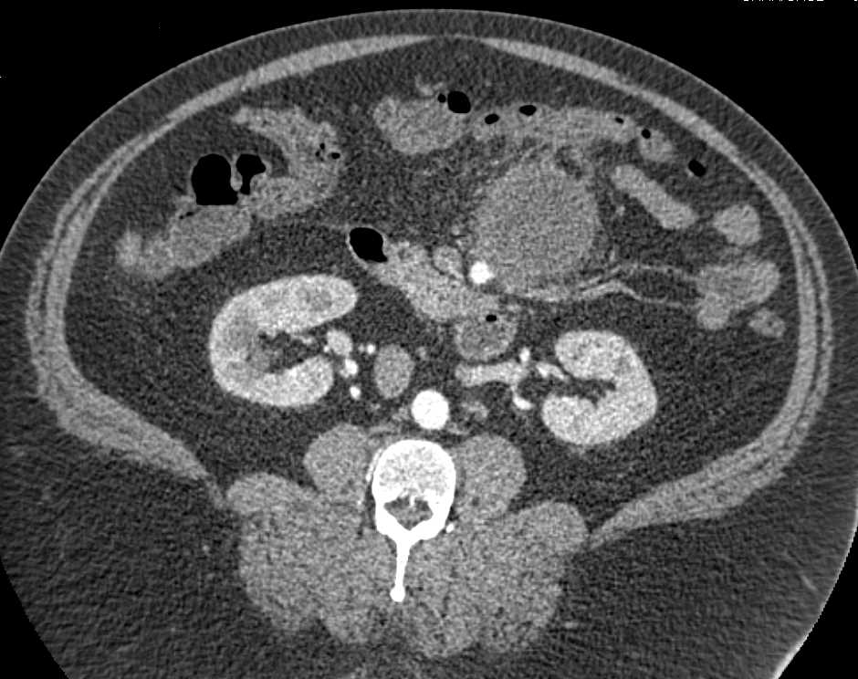 Lymphoma in the Mesentery with a Large Mass - CTisus CT Scan