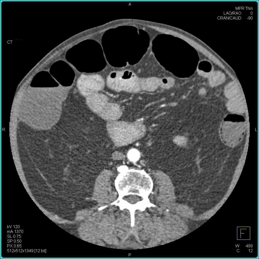 Ischemic Bowel and Pneumatosis - CTisus CT Scan