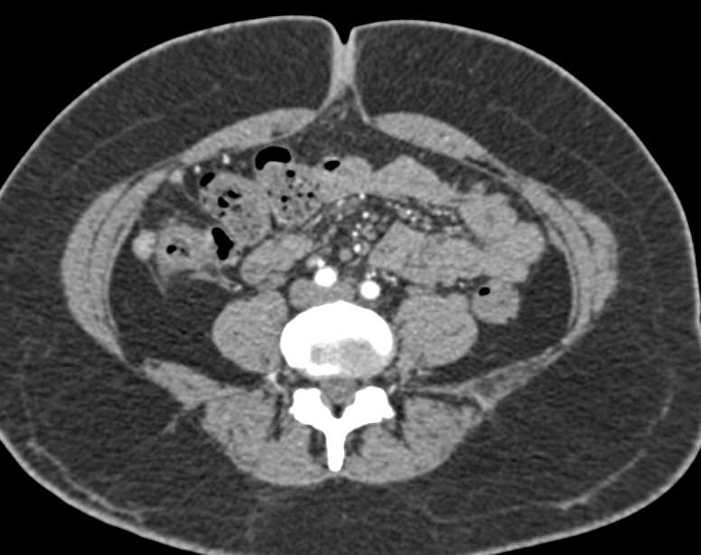 Tumor Implants in the Right Lower Quadrant - CTisus CT Scan