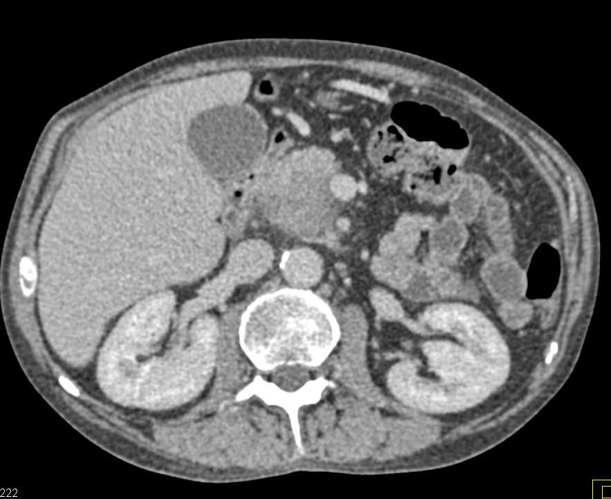 Peripancreatic Adenopathy and Implants - CTisus CT Scan