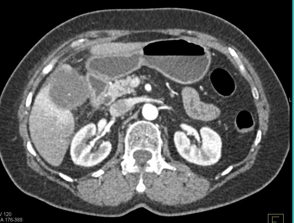 Acute Cholecystitis - CTisus CT Scan