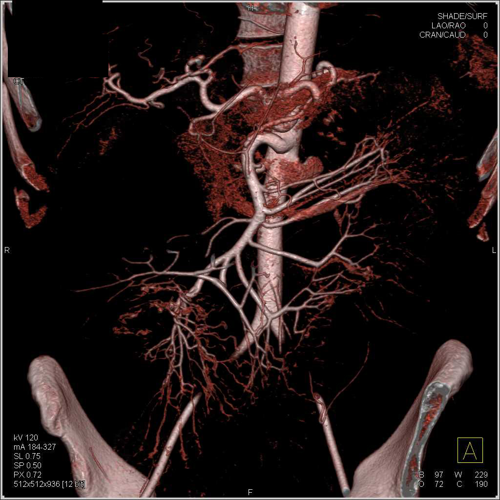 Small Bowel Obstruction (SBO) due to Crohn's Disease - CTisus CT Scan